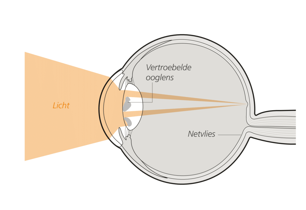 Kalmte pensioen Sinis Staar (cataract) - Eyescan