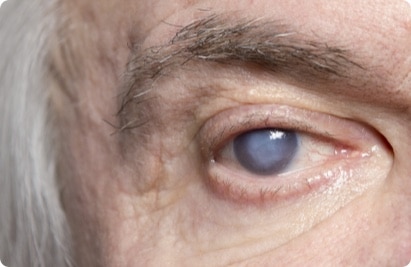 helder Bedreven vod Staar (cataract) - Eyescan
