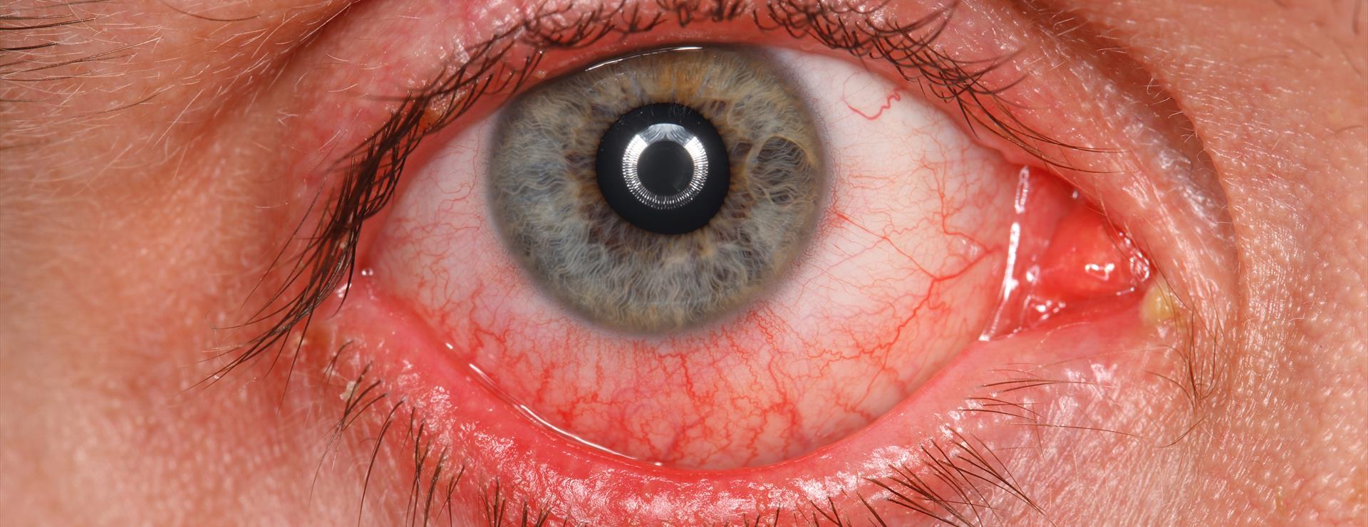 omvatten kom tot rust Farmacologie Ontstoken slijmvlies (conjunctivitis) - Eyescan