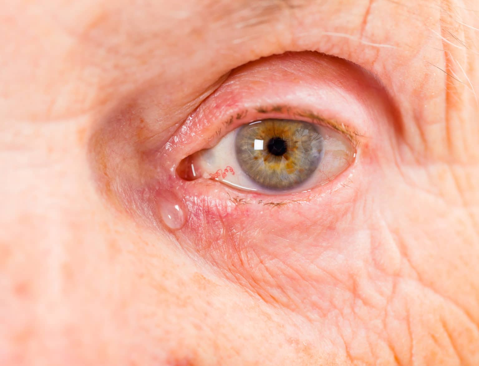 Oogaandoeningen - Eyescan