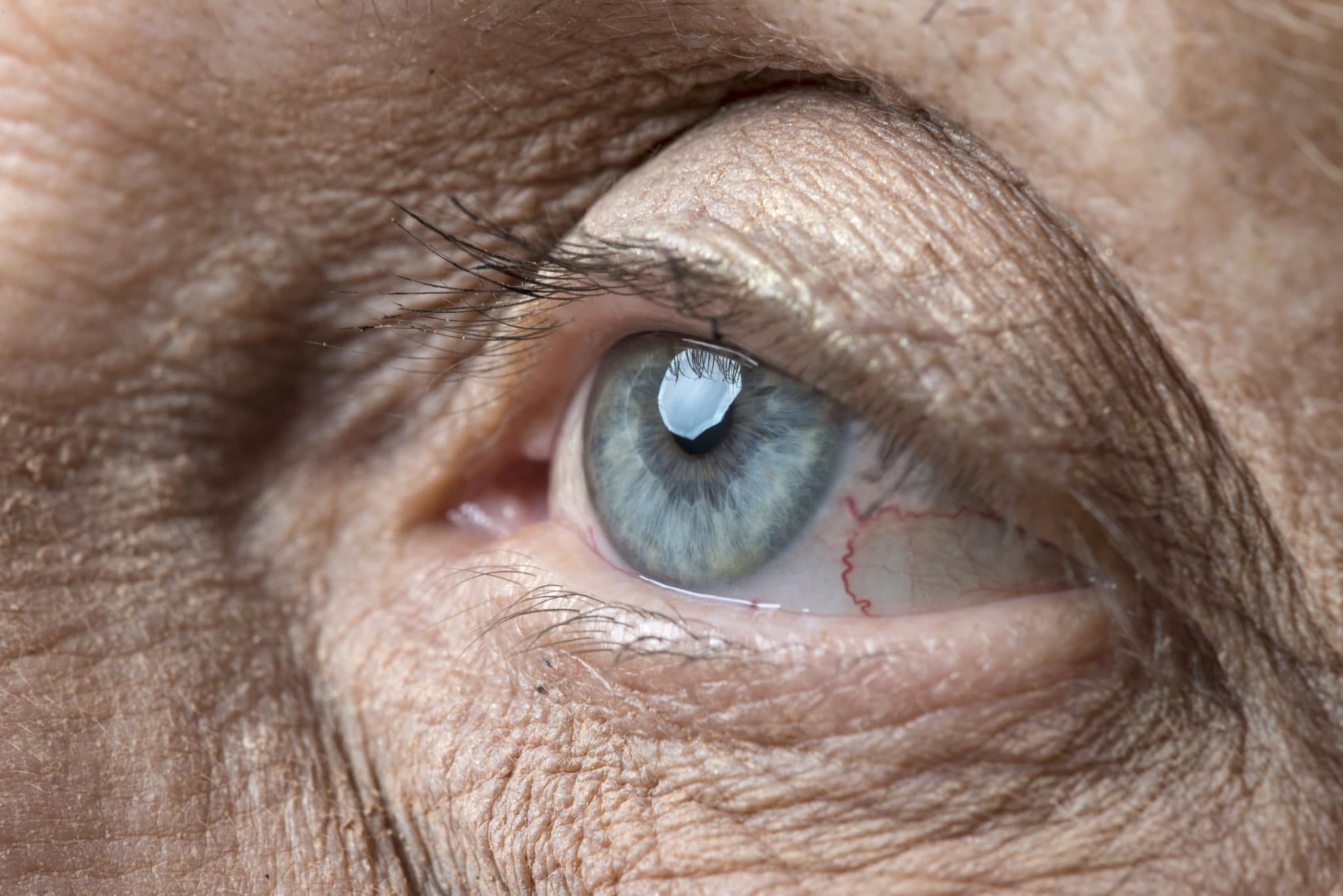 Luchten dauw opwinding Hoornvliesbeschadiging (cornea-erosie) - Eyescan